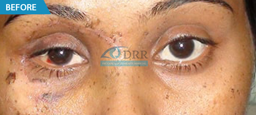 Chennai best Treatment for Eye injuries
